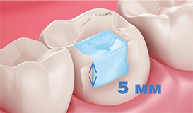 Jen Radiance Molar 1