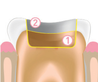 Jendental Ukraine jen radiance molar JRM tech